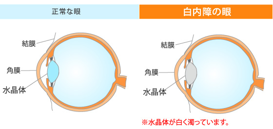 白内障の眼