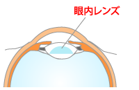 白内障手術図